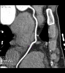 Minimal Plaque Right Coronary Artery (RCA) and Left Anterior Descending Coronary Artery (LAD) - CTisus CT Scan