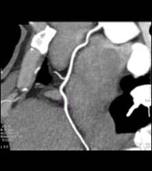 Minimal Plaque Right Coronary Artery (RCA) and Left Anterior Descending Coronary Artery (LAD) - CTisus CT Scan