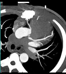 RCA Off Left Cusp Following Tunneling Procedure - CTisus CT Scan