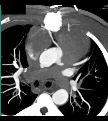 RCA Off Left Cusp Following Tunneling Procedure - CTisus CT Scan