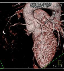 RCA Off Left Cusp Following Tunneling Procedure - CTisus CT Scan