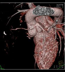 RCA Off Left Cusp Following Tunneling Procedure - CTisus CT Scan