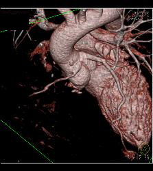 RCA Off Left Cusp Following Tunneling Procedure - CTisus CT Scan