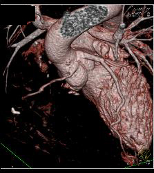 RCA Off Left Cusp Following Tunneling Procedure - CTisus CT Scan