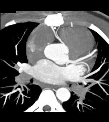 RCA Off Left Cusp Following Tunneling Procedure - CTisus CT Scan