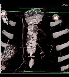 S/p Left Internal Mammary Artery (LIMA) and Venous Coronary Artery Bypass Graft (CABG) - CTisus CT Scan