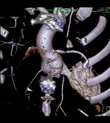 S/p Left Internal Mammary Artery (LIMA) and Venous Coronary Artery Bypass Graft (CABG) - CTisus CT Scan