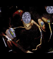 S/p Left Internal Mammary Artery (LIMA) and Venous Coronary Artery Bypass Graft (CABG) - CTisus CT Scan