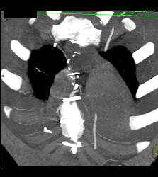 S/p Left Internal Mammary Artery (LIMA) and Venous Coronary Artery Bypass Graft (CABG) - CTisus CT Scan