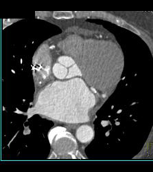 Perfectly Timed Coronary Artery Study Detects Subtle Incidental Pulmonary Embolism (PE) in Right Main Pulmonary Artery - CTisus CT Scan