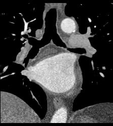 Perfectly Timed Coronary Artery Study Detects Subtle Incidental Pulmonary Embolism (PE) in Right Main Pulmonary Artery - CTisus CT Scan