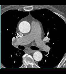 Perfectly Timed Coronary Artery Study Detects Subtle Incidental Pulmonary Embolism (PE) in Right Main Pulmonary Artery - CTisus CT Scan