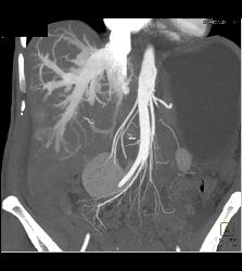 Reflux of Contrast Into IVC Because of Poor Right Sided Cardiac Function. Congested Hepatic Veins Seen in Multiple Perspectives - CTisus CT Scan