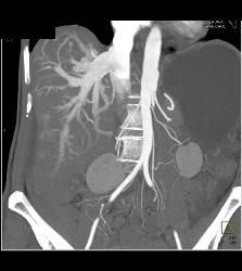 Reflux of Contrast Into IVC Because of Poor Right Sided Cardiac Function. Congested Hepatic Veins Seen in Multiple Perspectives - CTisus CT Scan