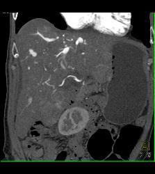 Reflux of Contrast Into IVC Because of Poor Right Sided Cardiac Function. Congested Hepatic Veins Seen in Multiple Perspectives - CTisus CT Scan