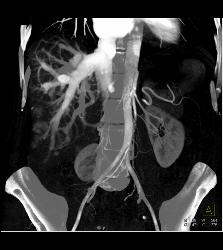 Reflux of Contrast Into IVC Because of Poor Right Sided Cardiac Function. Congested Hepatic Veins Seen in Multiple Perspectives - CTisus CT Scan