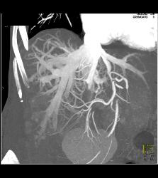 Reflux of Contrast Into IVC Because of Poor Right Sided Cardiac Function. Congested Hepatic Veins Seen in Multiple Perspectives - CTisus CT Scan