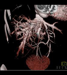 Reflux of Contrast Into IVC Because of Poor Right Sided Cardiac Function. Congested Hepatic Veins Seen in Multiple Perspectives - CTisus CT Scan