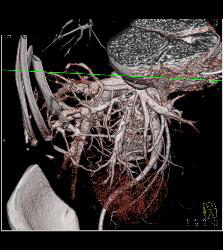 Reflux of Contrast Into IVC Because of Poor Right Sided Cardiac Function. Congested Hepatic Veins Seen in Multiple Perspectives - CTisus CT Scan