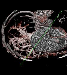 Reflux of Contrast Into IVC Because of Poor Right Sided Cardiac Function. Congested Hepatic Veins Seen in Multiple Perspectives - CTisus CT Scan