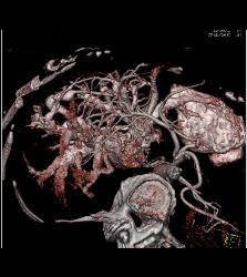 Reflux of Contrast Into IVC Because of Poor Right Sided Cardiac Function. Congested Hepatic Veins Seen in Multiple Perspectives - CTisus CT Scan