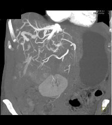 Reflux of Contrast Into IVC Because of Poor Right Sided Cardiac Function. Congested Hepatic Veins Seen in Multiple Perspectives - CTisus CT Scan