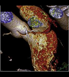 Calcified Left Anterior Descending Coronary Artery (LAD) Plaque Without Significant Stenosis - CTisus CT Scan