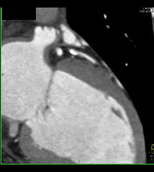 Calcified Left Anterior Descending Coronary Artery (LAD) Plaque Without Significant Stenosis - CTisus CT Scan