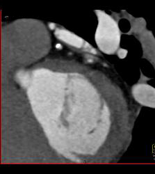 Calcified Left Anterior Descending Coronary Artery (LAD) Plaque Without Significant Stenosis - CTisus CT Scan