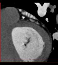 Calcified Left Anterior Descending Coronary Artery (LAD) Plaque Without Significant Stenosis - CTisus CT Scan