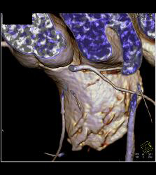 Calcified Left Anterior Descending Coronary Artery (LAD) Plaque Without Significant Stenosis - CTisus CT Scan