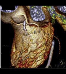 Calcified Left Anterior Descending Coronary Artery (LAD) Plaque Without Significant Stenosis - CTisus CT Scan