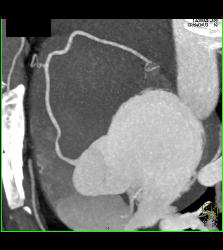 Minimal Plaque in Right Coronary Artery (RCA) - CTisus CT Scan