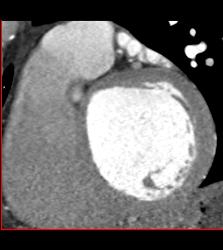 Minimal Left Anterior Descending Coronary Artery (LAD) Plaque - CTisus CT Scan