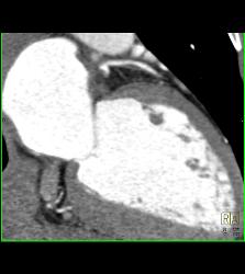 Minimal Left Anterior Descending Coronary Artery (LAD) Plaque - CTisus CT Scan