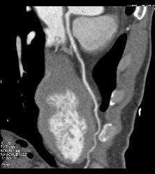 Minimal Left Anterior Descending Coronary Artery (LAD) Plaque - CTisus CT Scan