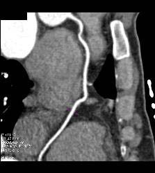 Minimal Left Anterior Descending Coronary Artery (LAD) Plaque - CTisus CT Scan