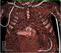 Pentalogy of Cantrell. Note Abdominal Wall Defect and Heart Extending Through Defect and Pulmonary Artery Stenosis - CTisus CT Scan