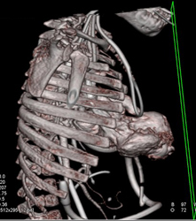 Pentalogy of Cantrell. Note Abdominal Wall Defect and Heart Extending Through Defect and Pulmonary Artery Stenosis - CTisus CT Scan