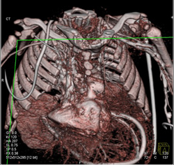 Pentalogy of Cantrell. Note Abdominal Wall Defect and Heart Extending Through Defect and Pulmonary Artery Stenosis - CTisus CT Scan