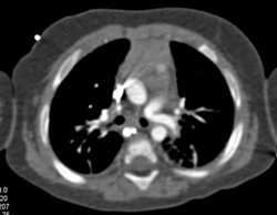 Pentalogy of Cantrell. Note Abdominal Wall Defect and Heart Extending Through Defect and Pulmonary Artery Stenosis - CTisus CT Scan