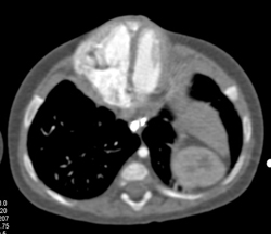 Pentalogy of Cantrell. Note Abdominal Wall Defect and Heart Extending Through Defect and Pulmonary Artery Stenosis - CTisus CT Scan