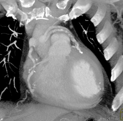 Bypass Venous Grafts - CTisus CT Scan