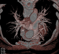 Bypass Venous Grafts - CTisus CT Scan