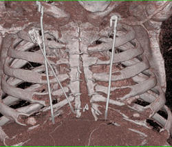 Medial Sternotomy - CTisus CT Scan