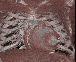 Medial Sternotomy - CTisus CT Scan