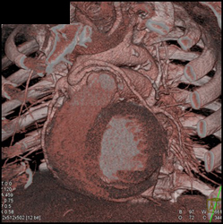 Medial Sternotomy - CTisus CT Scan