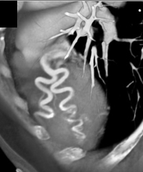 Dilated Coronary Artery in An Er Patient - CTisus CT Scan