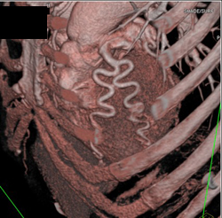 Dilated Coronary Artery in An Er Patient - CTisus CT Scan