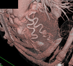 Dilated Coronary Artery in An Er Patient - CTisus CT Scan